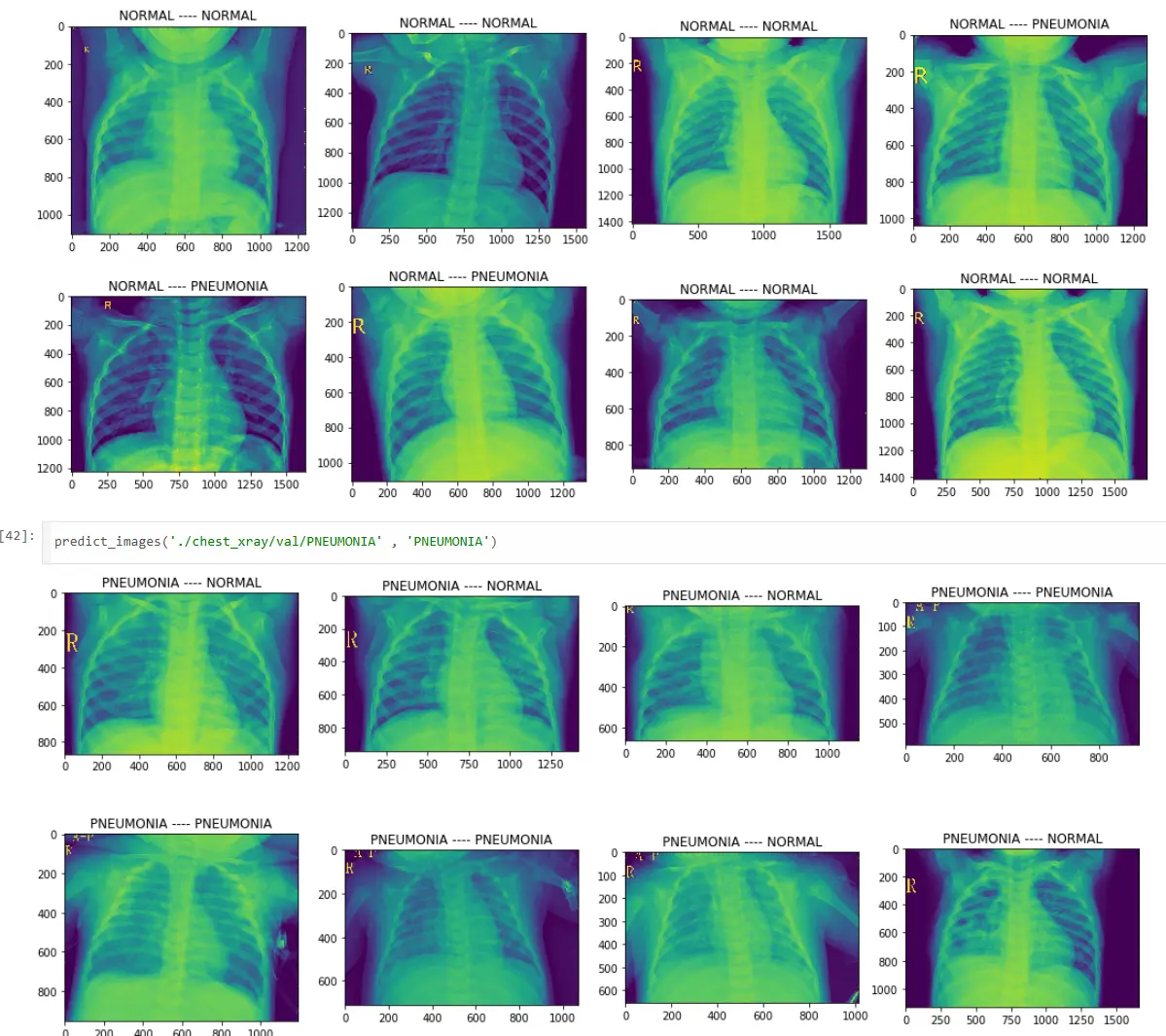 Transfer learning model predictions on chest X-rays showing normal and pneumonia classifications